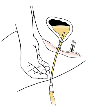 Cross section of catheter in urethra, draining urine from bladder.