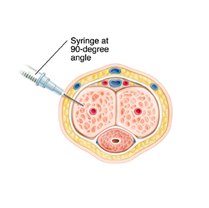Cross section of soft penis with syringe demonstrating penile self-injection.