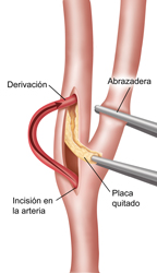 Endoarterectomía de carótida