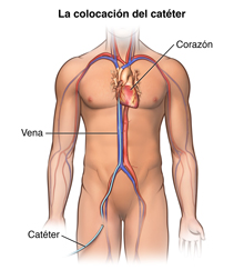 El cuerpo de un hombre con un catéter insertado en la pierna y llega hasta una arteria del corazón. 