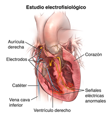 Ubicación de los electrodos en el corazón durante un estudio electrofisiológico.