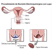 Ilustración del procedimiento de escisión electroquirúrgica