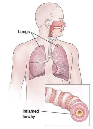 Location of lungs in chest, with detail of inflamed airway.